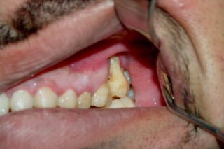 Gencive abîmée par le snus. DR